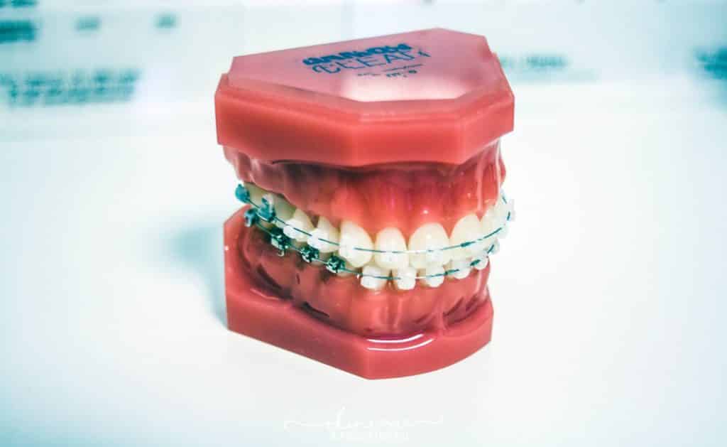 apparecchio per i denti